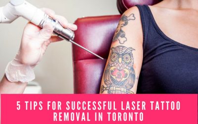 5 Tips for Successful Laser Tattoo Removal in Toronto