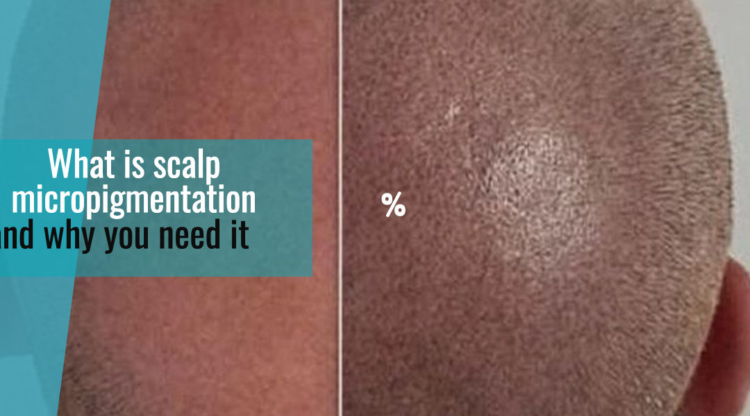 What is scalp micropigmentation and why you need it