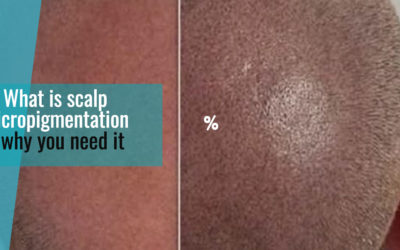 What is scalp micropigmentation and why you need it