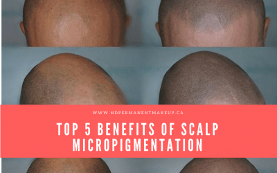 Top 5 Benefits of Scalp Micropigmentation