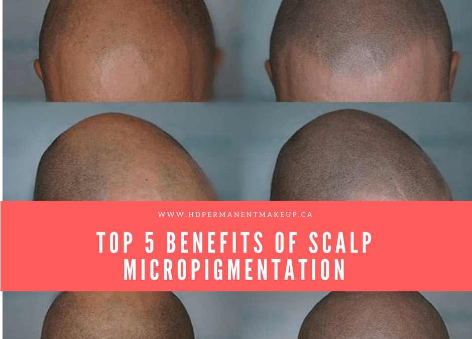 Top 5 Benefits of Scalp Micropigmentation