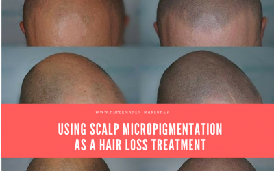 Scalp Micropigmentation as a Hair Loss Treatment