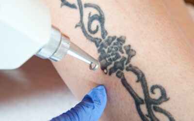 Top 5 Common Reasons for Tattoo Removal