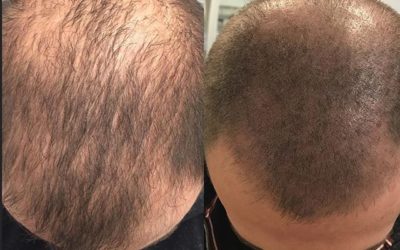 10 Things You Need to Know about Scalp Micropigmentation