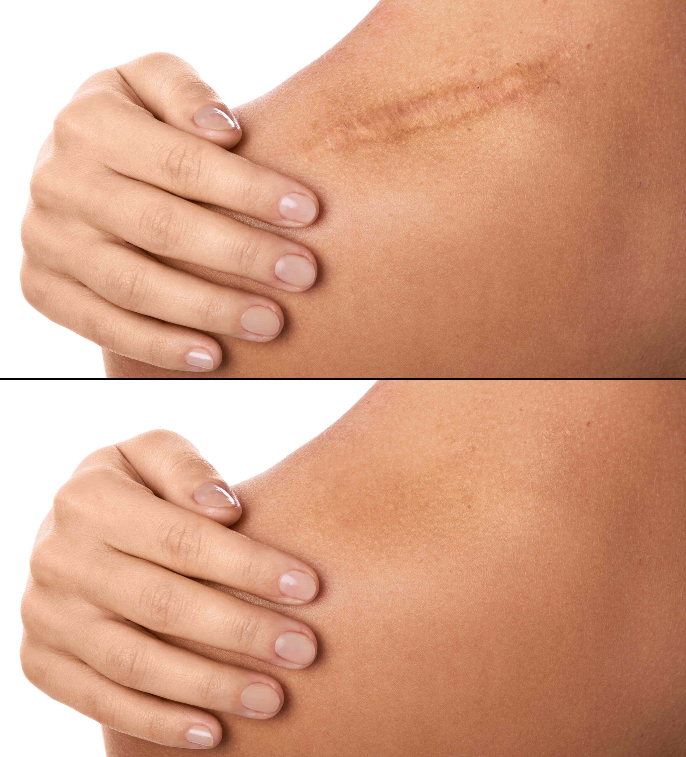 Photo of Scar Camouflage Before and After